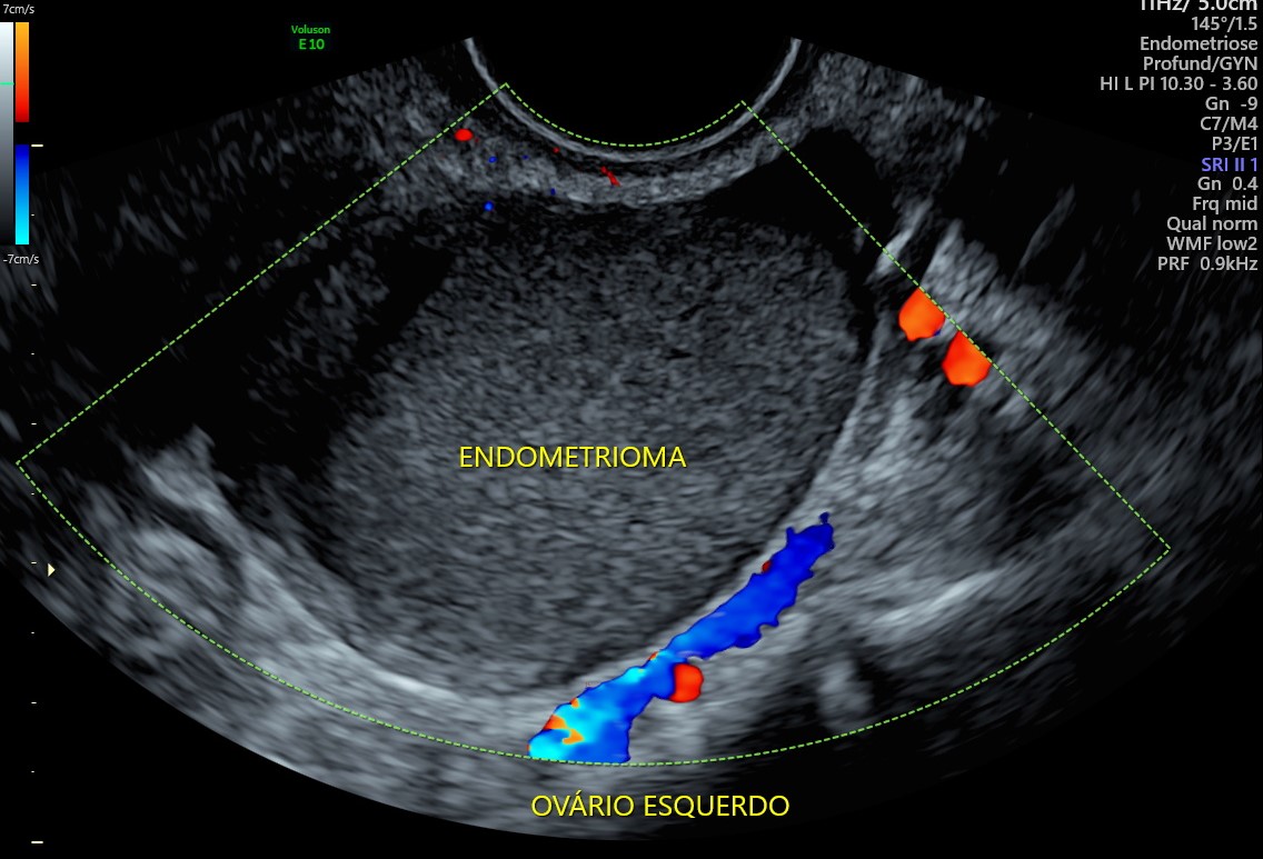 Se você sente muita cólica e cansaço no período menstrual, atenção com a endometriose